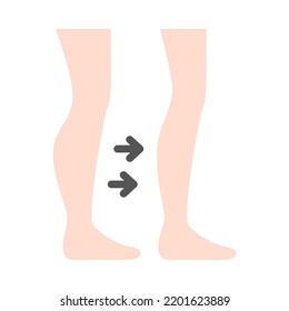 Calf Liposuction Flat Design. Calf Cosmetic Surgery. For Plastic Surgery Clinic, Medical And Beauty Publications. Vector Illustration.