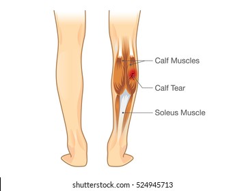Calf muscle tear. Illustration about leg Injury from inflammatory.
