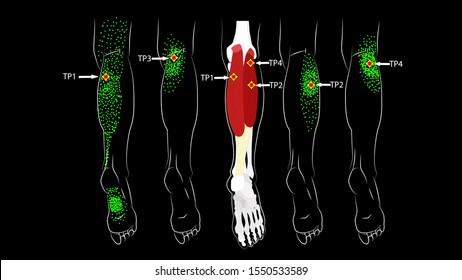 Calf muscle. Trigger points in the leg, reflected pain on the back of the thigh and in the foot. Leg pain