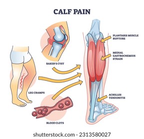 Calf pain explanation with cramp from muscle contraction outline diagram. Labeled educational scheme with leg anatomy and medical cause of sore rupture, strain or inflammation vector illustration.