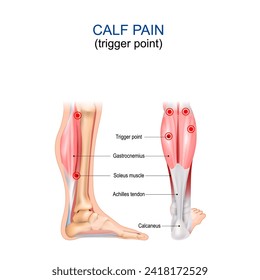 Dolor de ternera. Punto desencadenante. Gastrocnemius, músculo Soleus, tendón de Aquiles y Calcaneus. Síndrome de dolor miofascial. Anatomía corporal humana. Ilustración del vector