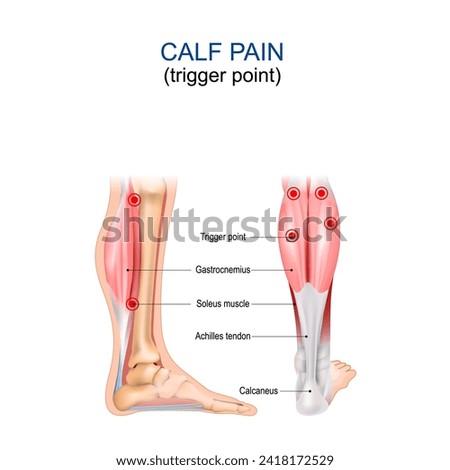 Calf pain. Trigger point. Gastrocnemius, Soleus muscle, Achilles tendon and Calcaneus. Myofascial pain syndrome. Human body anatomy. Vector illustration