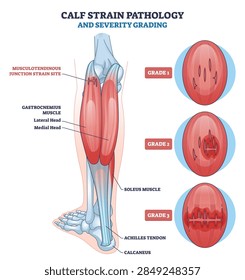 Calf strain pathology grading visual shows gastrocnemius, soleus, and Achilles tendon with grade 1 3 tear stages, mapping injury sites and anatomy. Outline diagram