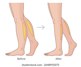 Panturrilhas antes e depois da perda de peso. Emagrecimento da ilustração do vetor de panturrilhas.