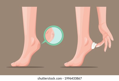 callus cracked heel and skin lotion cream product symbol concept in cartoon realistic illustration vector