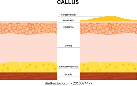 Afiche médico de Callus. Área de piel gruesa y densa en los pies humanos. Pancarta de la clínica de dermatología con piel hinchada y maíz redondo doloroso. Células muertas en el nivel de epidermis ilustraciones vectoriales planas