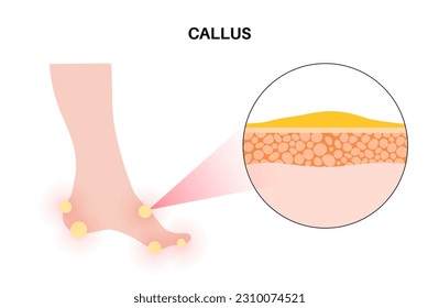 Afiche médico de Callus. Área de piel gruesa y densa en los pies humanos. Pancarta de la clínica de dermatología con piel hinchada y maíz redondo doloroso. Células muertas en el nivel de epidermis ilustraciones vectoriales planas