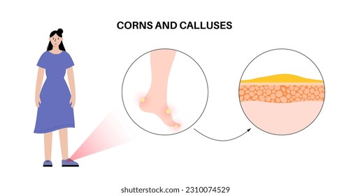 Afiche médico de Callus. Área de piel gruesa y densa en los pies humanos. Pancarta de la clínica de dermatología con piel hinchada y maíz redondo doloroso. Células muertas en el nivel de epidermis ilustraciones vectoriales planas