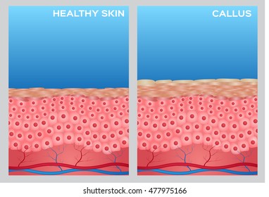 callus skin anatomy and healthy