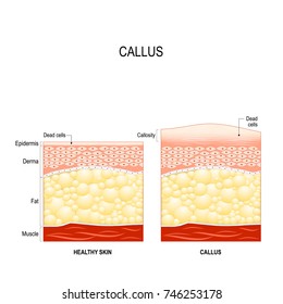 Callus is a toughened area of skin with relatively thick layer of the dead cells. callosity. The difference between healthy skin and skin with callus. skincare