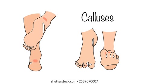 Calos. Endurecimento local da pele causado por atrito e pressão prolongados. Pés puxados à mão com calos nas áreas mais comuns de ocorrência. Vetor isolado no fundo branco. 