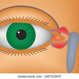 Canaliculitis. Inflammation of lacrimal canals. The structure of the eye. Infographics. Vector illustration.