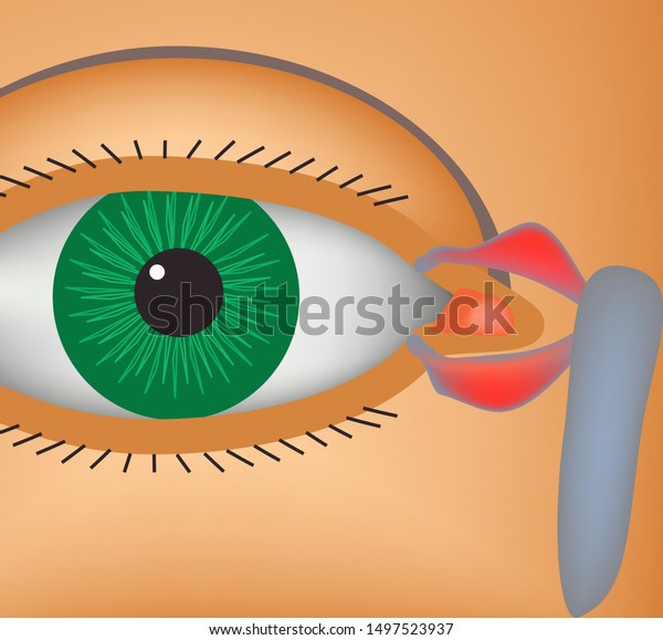 lacrimal sac inflammation