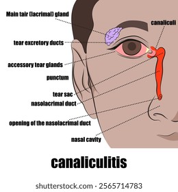 canaliculitis, inflammation of the tear duct (usually caused by an infection).