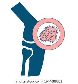 Cancer Bone Icon. 
Osteogenic Sarcoma Is A Cancerous Tumor In A Bone Line Color Icon. Human Anatomy Concept. Malignant Neoplasm. Sign For Web Page, Mobile App, Button, Logo. Vector Isolated Element. 