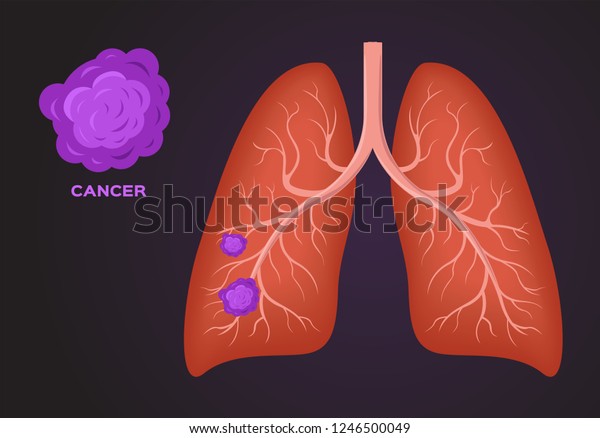 Cancer Cell On Lung Vector Stock Vector (Royalty Free) 1246500049 ...