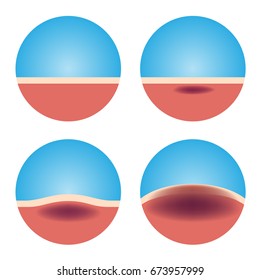 cancer cell Spreading through the skin vector