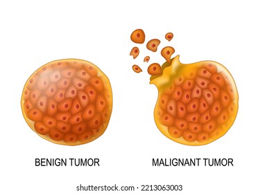 Cancer cells in Benign neoplasm and Malignant tumors. Close-up of carcinocytes that have the ability to metastasis. Cells of non-cancerous tumor are surrounded by a fibrous sheath of connective tissue