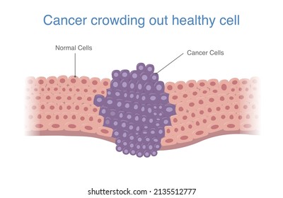 Cancer cells crowd out the healthy cells. medical diagram about Cancer metastasis that will develop to the tumor.