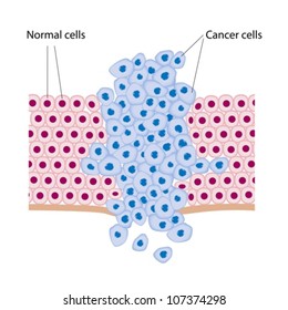 Cancer cells in a growing tumor