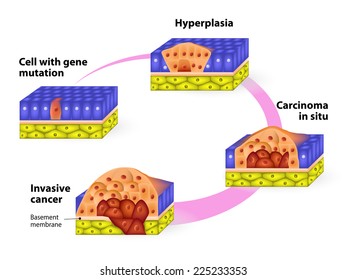 Cancer. Cancer Cells In A Growing Tumor. Stages Of Carcinogenesis