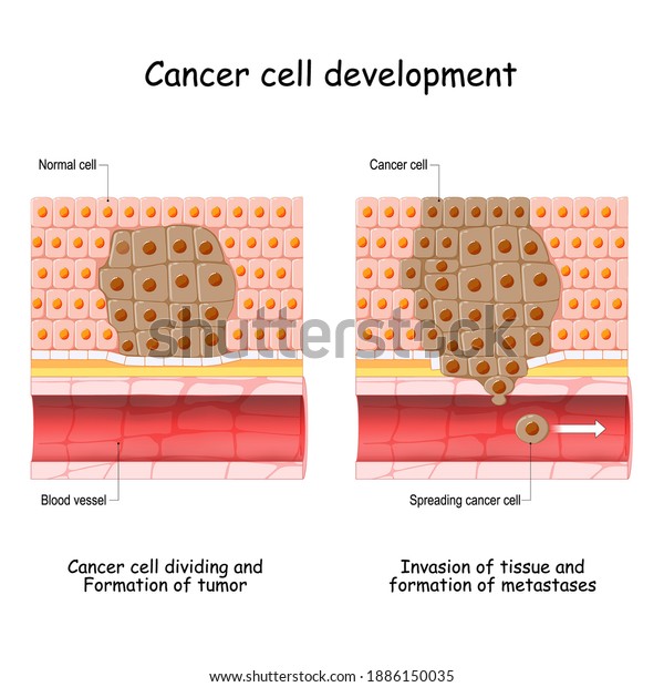 Cancer Development Normal Cell Formation Tumor Stock Vector (Royalty ...