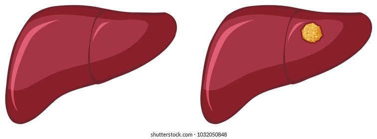 Cancer in human liver on white background illustration
