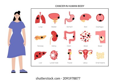 Cancer in Internal organs. Tumor in woman body medical concept. Liver, intestine, bladder, and other organs with neoplasm icons in female silhouette. Pain and inflammation flat vector illustration.