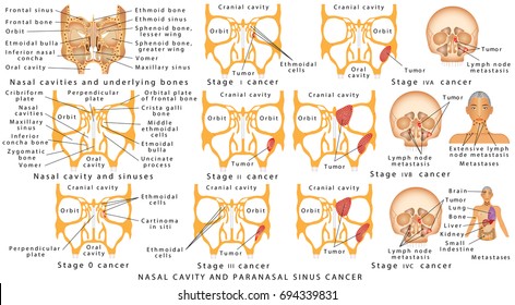 nasal cancer