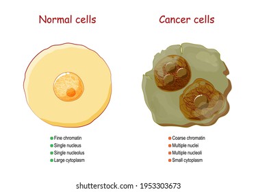 Cancer and normal cells. comparison and difference between healthy tissue and tumor. details about chromatin, nucleus and cytoplasm. Vector illustration