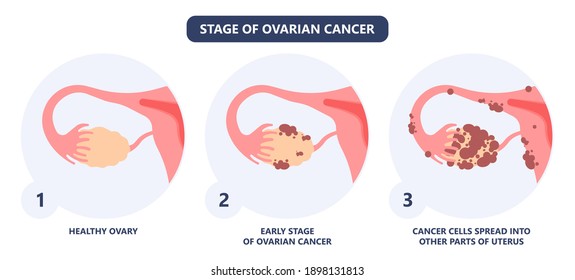 Cancer Pelvic PCOS Ovary Endo Belly Pain Swelling Uterus Heavy Ovaries Cysts Examine Surgery Remove Pregnancy Endobelly Tube Cycle Period Fertility Problem Diagnosis Menstruation Cell Polyp Cervical