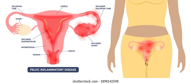 Cancer Pelvic PCOS Ovary Endo Belly Pain Swelling Uterus Heavy Ovaries Cysts Examine Surgery Remove Pregnancy Endobelly Tube Cycle Period Fertility Problem Diagnosis Menstruation Cell Polyp Cervical