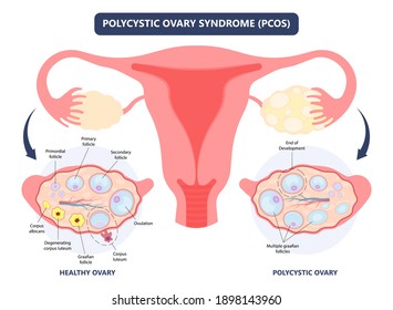 Cancer pelvic PCOS ovary Endo belly pain swelling uterus heavy ovaries cysts examine surgery remove pregnancy endobelly tube cycle period Fertility problem diagnosis menstruation cell polyp cervical