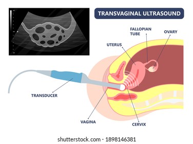 Cancer Pelvic PCOS Ovary Endo Belly Pain Swelling Uterus Heavy Ovaries Cysts Examine Surgery Remove Pregnancy Endobelly Tube Cycle Period Fertility Problem Diagnosis Menstruation Cell Polyp Cervical