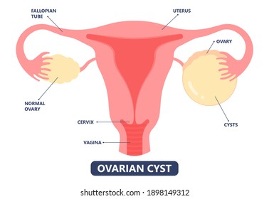 Cancer Pelvic PCOS Ovary Endo Belly Pain Swelling Uterus Heavy Ovaries Cysts Examine Surgery Remove Pregnancy Endobelly Tube Cycle Period Fertility Problem Diagnosis Menstruation Cell Polyp Cervical