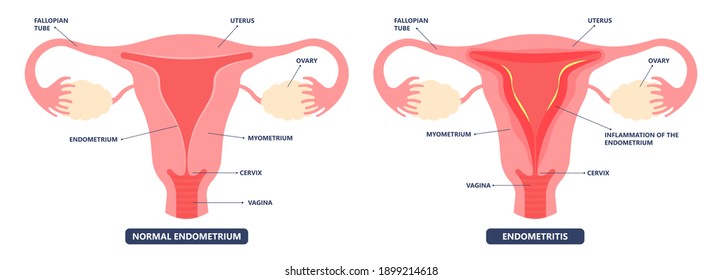 Cancer pelvic PCOS ovary Endo belly pain swelling uterus heavy ovaries cysts examine surgery remove pregnancy endobelly tube cycle period Fertility problem diagnosis menstruation cell polyp cervical