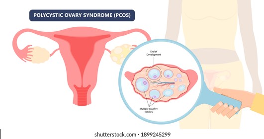 Cancer pelvic PCOS ovary Endo belly pain swelling uterus heavy ovaries cysts examine surgery remove pregnancy endobelly tube cycle period Fertility problem diagnosis menstruation cell polyp cervical