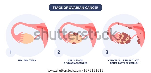 Cancer Pelvic Pcos Ovary Endo Belly Stock Vector (Royalty Free ...