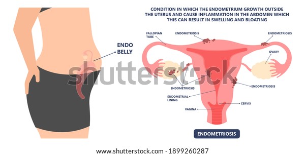 Cancer pelvic PCOS ovary Endo belly pain\
swelling uterus heavy ovaries cysts examine surgery remove\
pregnancy endobelly tube cycle period Fertility problem diagnosis\
menstruation cell polyp\
cervical