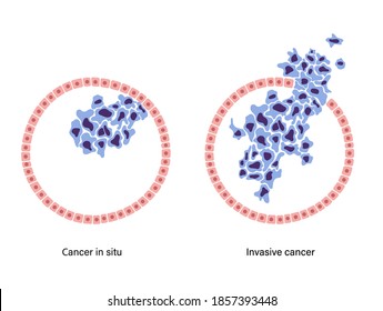 Cancer in situ and invasive cancer cells diagram. Tumor development in the human body concept. Flat vector illustration for clinic or hospital. Medical exam, laboratory and genetic research.