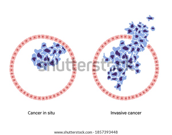 Cancer Situ Invasive Cancer Cells Diagram Stock Vector (Royalty Free ...