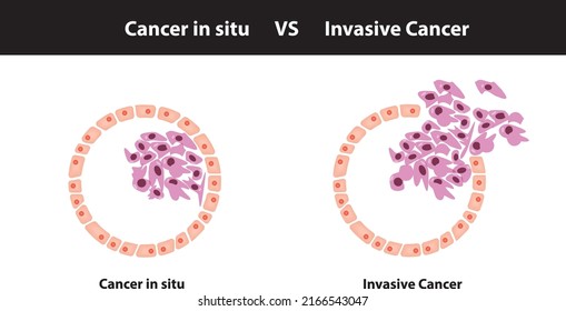 Cancer in situ vs invasive cancer cells illustration. Tumor cell progression and development in the human body. Cancer development illustration for clinics, hospitals, medical research, and lab.