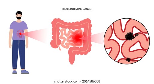 Cáncer en intestino delgado. Concepto de tumor estromal gastrointestinal. Desarrollo de la enfermedad en el sistema digestivo. Dolor e inflamación en el cuerpo humano. Examen de órganos internos ilustración vectorial plana.