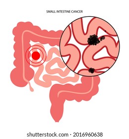 Cancer in small intestine. Gastrointestinal stromal tumor concept. Development of disease in the digestive system. Pain and inflammation in human body. Internal organs exam flat vector illustration.