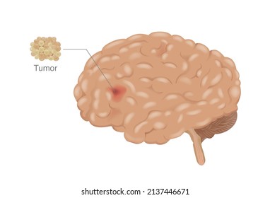 Cancer spreads to the human brain that develops be a tumor. medical diagram about Cancer metastasis at the human internal organ.