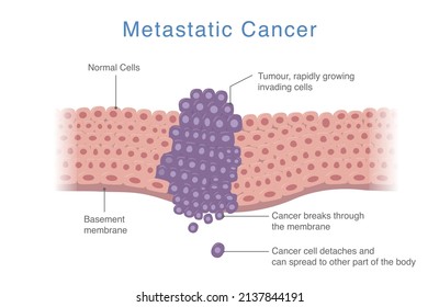 Cancer spreads from one part of the body to other parts. Medical diagram about Process of Metastatic cancer that develops to the tumor.