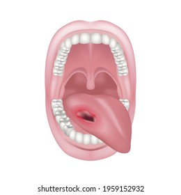 cancer of the tongue, oral cavity. The wound is in the mouth. Oncology. Jaw anatomy. Vector illustration