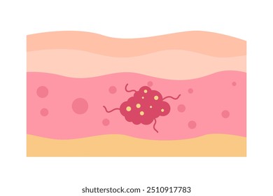 cancer tumor cell disease concept