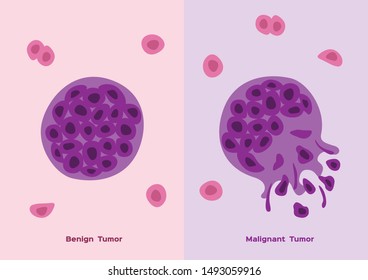 Cancer cells benign malignant - Cancer vs benign tumor