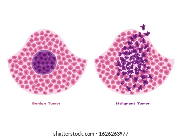 Cancer vs benign tumor, Email citation